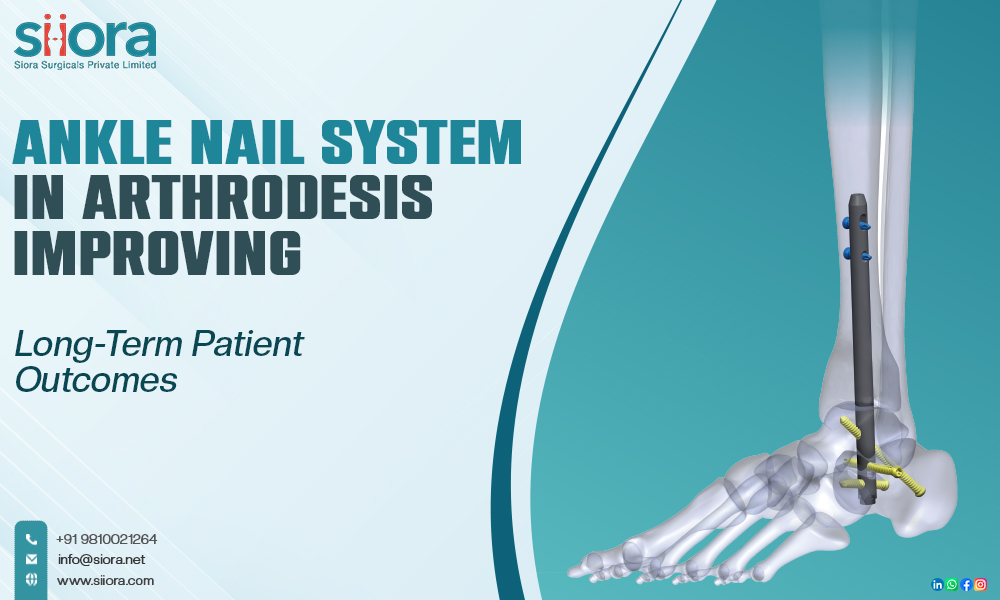 Ankle Nail System in Arthrodesis: Improving Long-Term Patient Outcomes